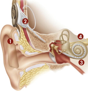 Cochlear Implantation Diagram